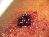 keratosis solar