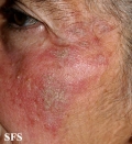 keratosis solar