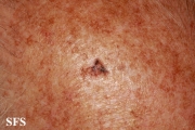 keratosis solar