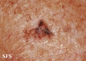 keratosis solar