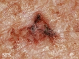keratosis solar