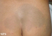 mongolian spot