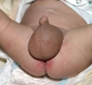 hydrocele