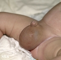 hydrocele