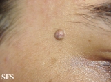pilomatricoma