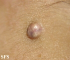 pilomatricoma