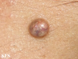 pilomatricoma
