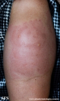 frostbite