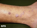 prurigo nodularis