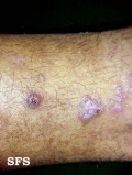 prurigo nodularis
