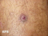 prurigo nodularis