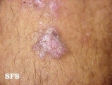 prurigo nodularis