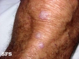 prurigo nodularis