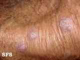 prurigo nodularis