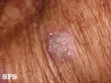 prurigo nodularis