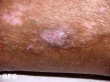 prurigo nodularis