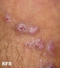 prurigo nodularis