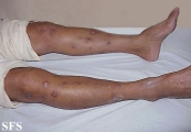 prurigo nodularis
