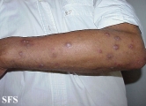 prurigo nodularis