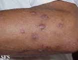 prurigo nodularis