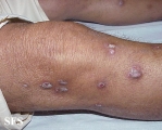 prurigo nodularis