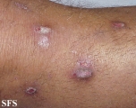 prurigo nodularis
