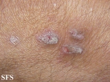 prurigo nodularis