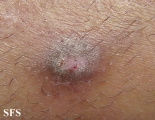 prurigo nodularis