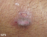 prurigo nodularis