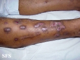 prurigo nodularis