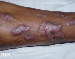 prurigo nodularis