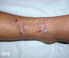 prurigo nodularis