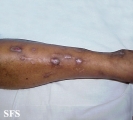 prurigo nodularis