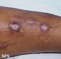 prurigo nodularis