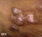 prurigo nodularis