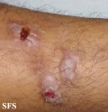 prurigo nodularis