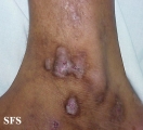 prurigo nodularis