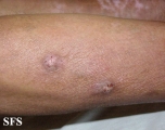 prurigo nodularis