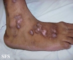 prurigo nodularis