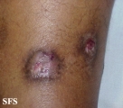 prurigo nodularis