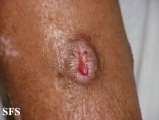 prurigo nodularis