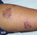 prurigo nodularis
