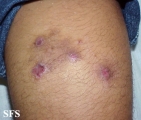 prurigo nodularis