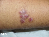 prurigo nodularis
