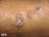 prurigo nodularis