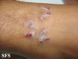 prurigo nodularis