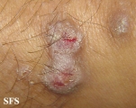 prurigo nodularis