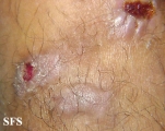 prurigo nodularis