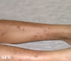prurigo nodularis