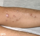 prurigo nodularis